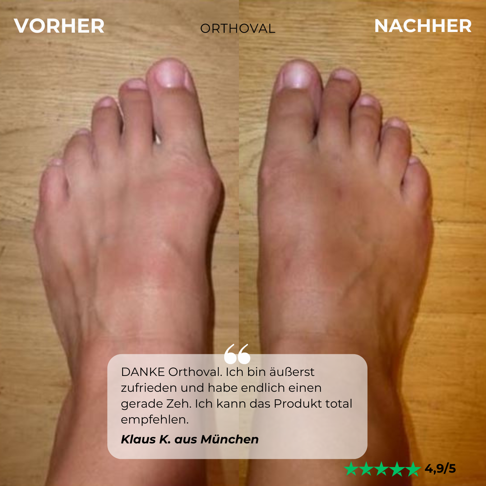 Attelle Orthoval pour correction des orteils