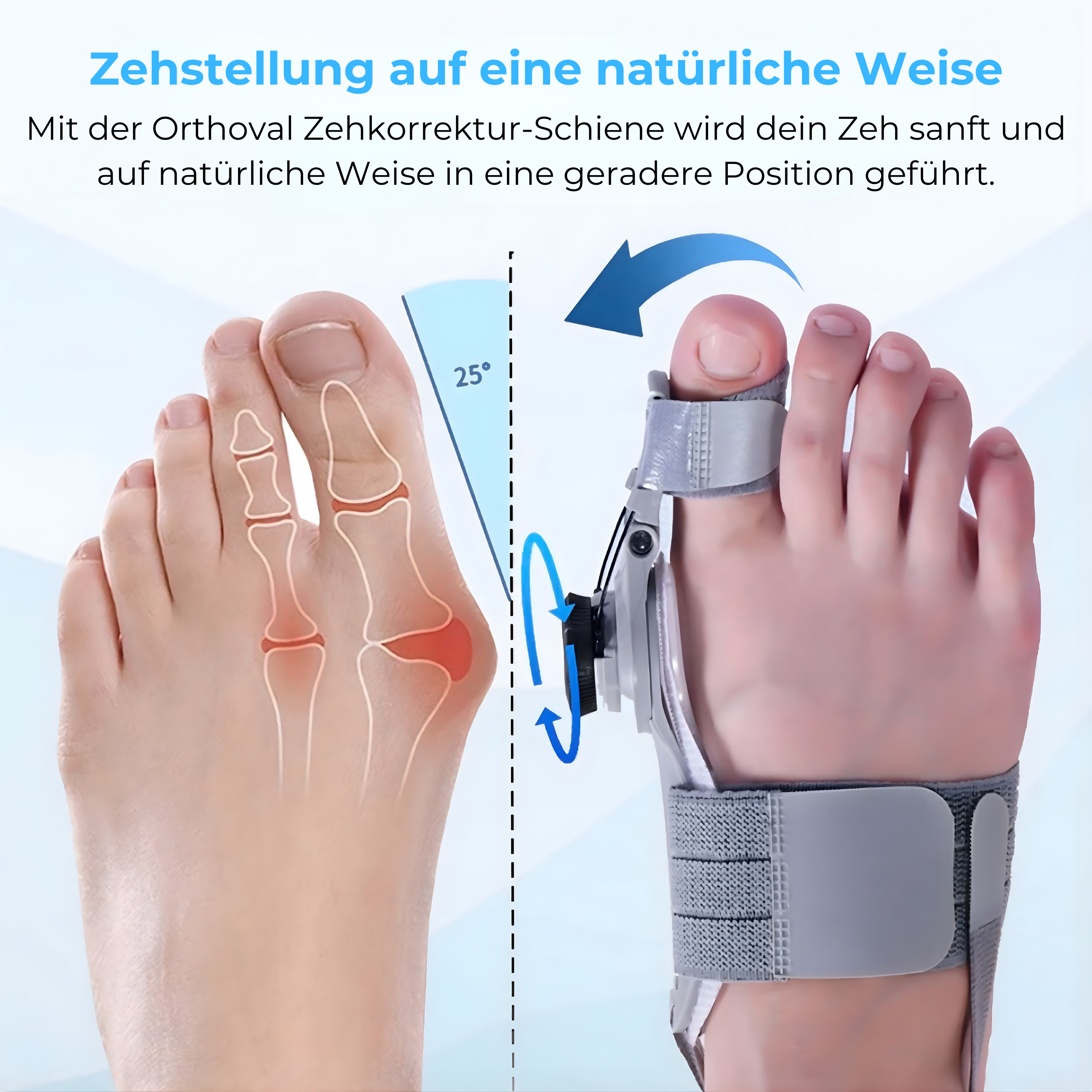 Attelle Orthoval pour correction des orteils